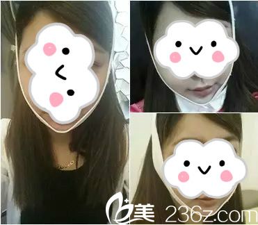 改脸型手术6周 改脸型手术6周