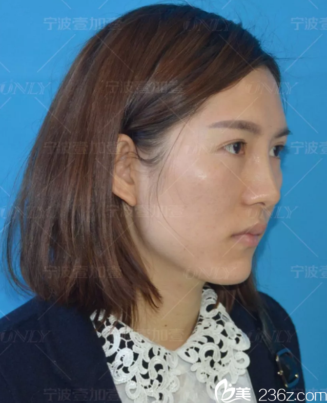 做自体脂肪填充前的照片 做自体脂肪填充前的照片