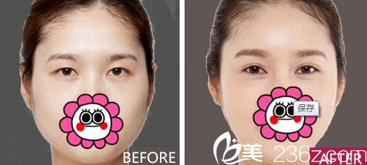 重庆新铜雀台整形双眼皮实例 重庆新铜雀台整形双眼皮实例