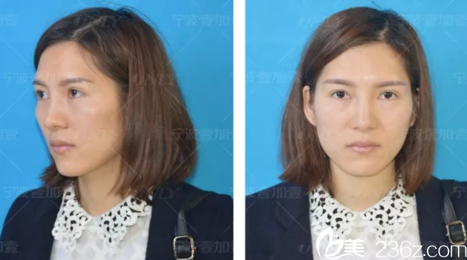 做自体脂肪填充前的侧面照片 做自体脂肪填充前的侧面照片