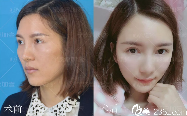 自体脂肪填充手术15天<span style= 自体脂肪填充手术15天<span style=