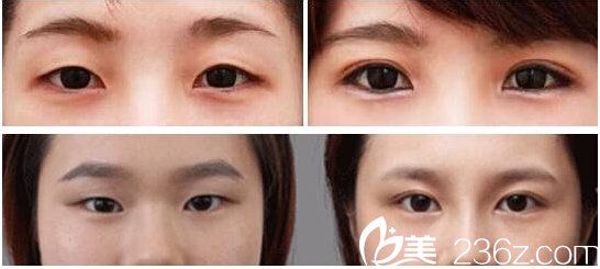 伞光院长双眼皮案例