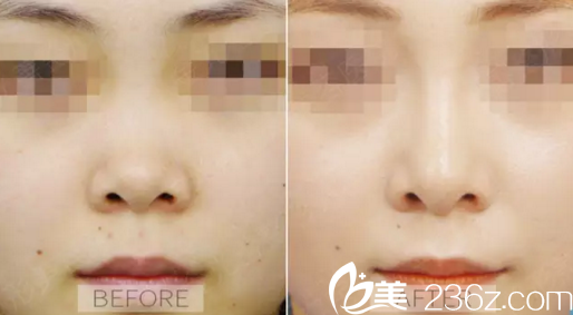 重庆新铜雀台整形李信奎隆鼻案例 重庆新铜雀台整形李信奎隆鼻案例