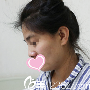 做鼻综合术前 做鼻综合术前