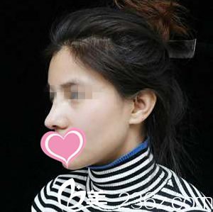 一周拆线 一周拆线