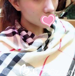 术后十五天效果 术后十五天效果