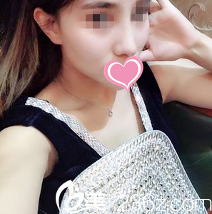 看我找大连达美元辰董世强做鼻综合术后一个月恢复效果