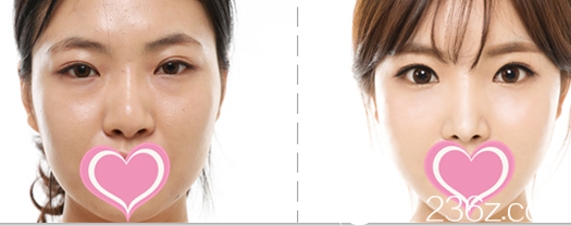 韩国希克丽整形外科医院案例 韩国希克丽整形外科医院案例