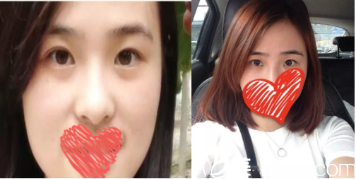 面诊<!--<i data=20240703-sp></i>-->医院后选择了西安高一生做全切双眼皮的原因 面诊<!--<i data=20240703-sp></i>-->医院后选择了西安高一生做全切双眼皮的原因