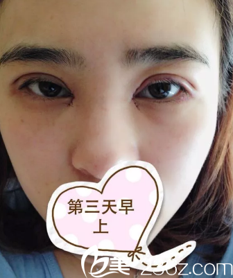 到现在还是很肿 到现在还是很肿