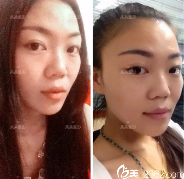 到集美做鼻修复前的元元