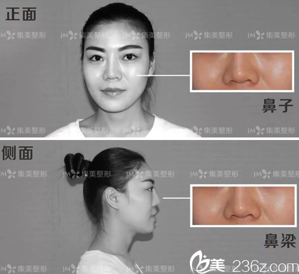 元元做鼻失败修复手术前分析