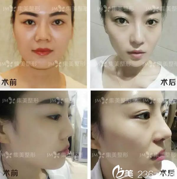 郑州集美鼻失败修复1个月恢复照