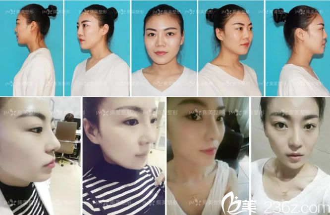 鼻修复手术前后全方位效果对比图