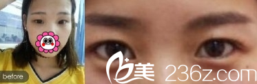 重庆新铜雀台做全切双眼皮案例术前 重庆新铜雀台做全切双眼皮案例术前