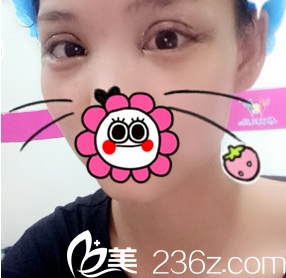 在重庆新铜雀台做完双眼皮2天照片 在重庆新铜雀台做完双眼皮2天照片