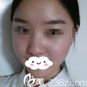 手术后一个月 手术后一个月