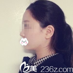 术后50多天 术后50多天