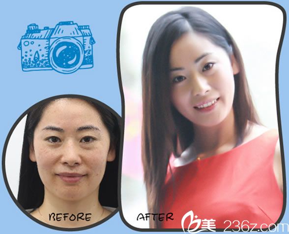 宁波静港李艳激光祛斑真人案例 宁波静港李艳激光祛斑真人案例