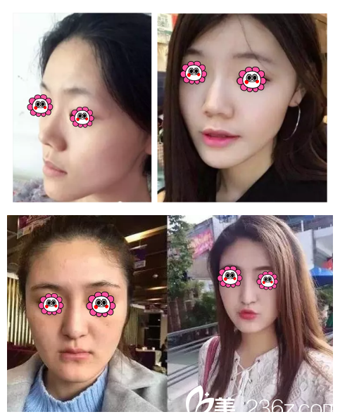 王培院长做自体脂肪填充面部案例 王培院长做自体脂肪填充面部案例