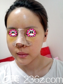 刚做完鼻子和面部填充的样子