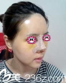 术后5天鼻子和面部慢慢恢复中