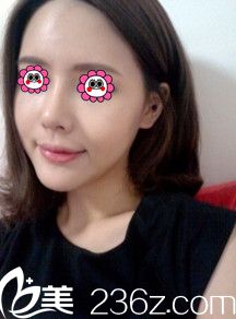 做完隆鼻和自体脂肪填充10天后的样子