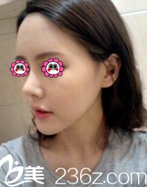 术后20天鼻子和面部正在恢复中