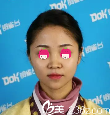 假体隆鼻加耳软骨垫鼻尖前的我 假体隆鼻加耳软骨垫鼻尖前的我