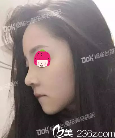 拆线了,第八天 拆线了,第八天