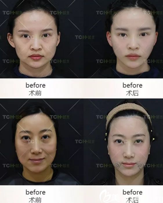 杭州时光面部线雕提升苹果肌案例