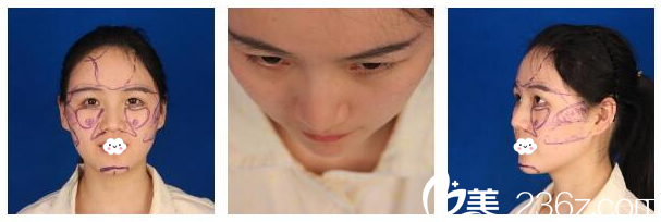 隆鼻术前照片
