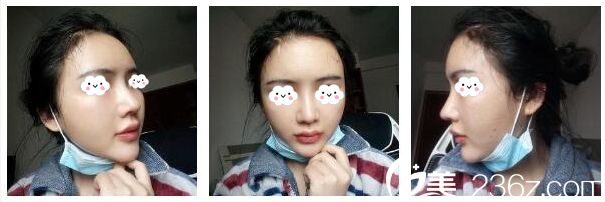 李波主任为我做完隆鼻9天了