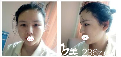 隆鼻6天拆线效果