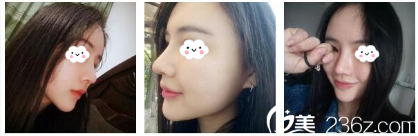 隆鼻术后20天恢复效果图