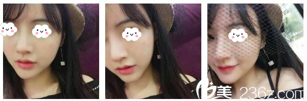 隆鼻术后20天自拍