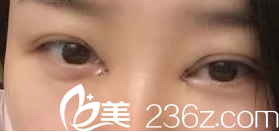 术后第三天照片 术后第三天照片