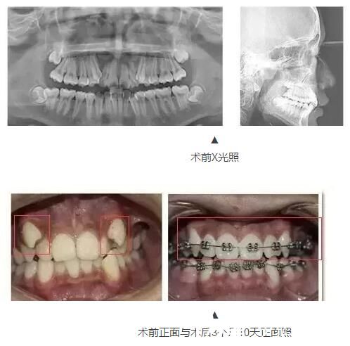 金属矫正牙齿不整齐 金属矫正牙齿不整齐