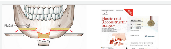 钻石截骨术+下颌角缩小手术方法示意图