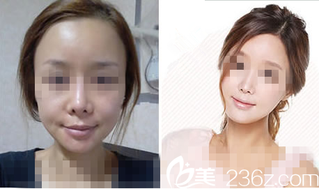 韩国丽妃整形外科真人案例 韩国丽妃整形外科真人案例