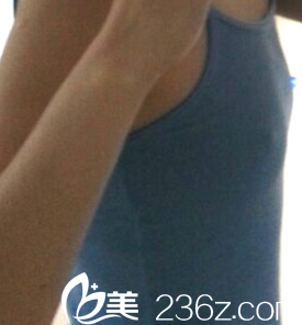 胸整形前照片 胸整形前照片