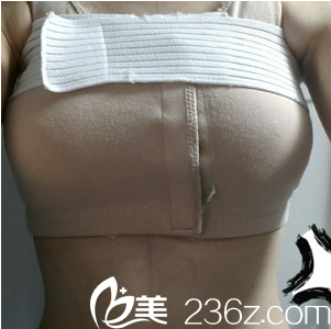 假体隆胸手术当天 假体隆胸手术当天