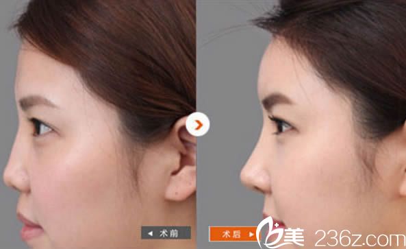 厦门华美医院贾虹假体隆鼻对比效果图 厦门华美医院贾虹假体隆鼻对比效果图