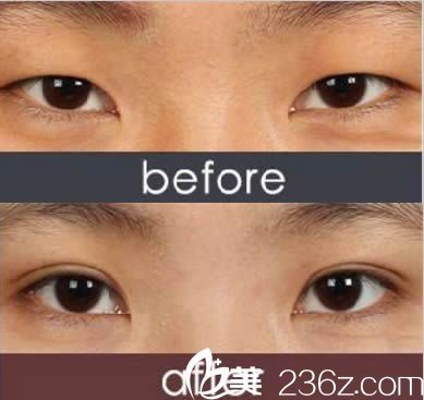 厦门华美陈运生双眼皮案例