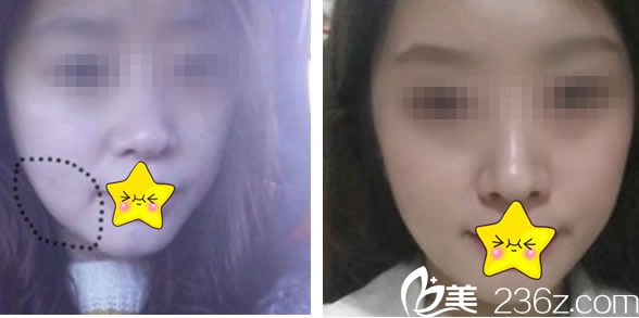 兰州仁和面部线雕提升效果