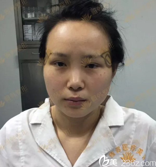 在雅韩做鼻子之前的塌鼻子照片 在雅韩做鼻子之前的塌鼻子照片