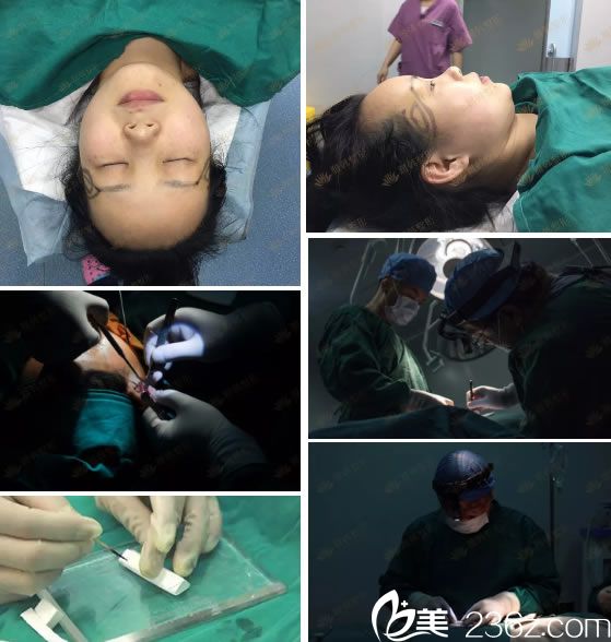 宁波雅韩龚涛耳软骨鼻综合手术过程 宁波雅韩龚涛耳软骨鼻综合手术过程