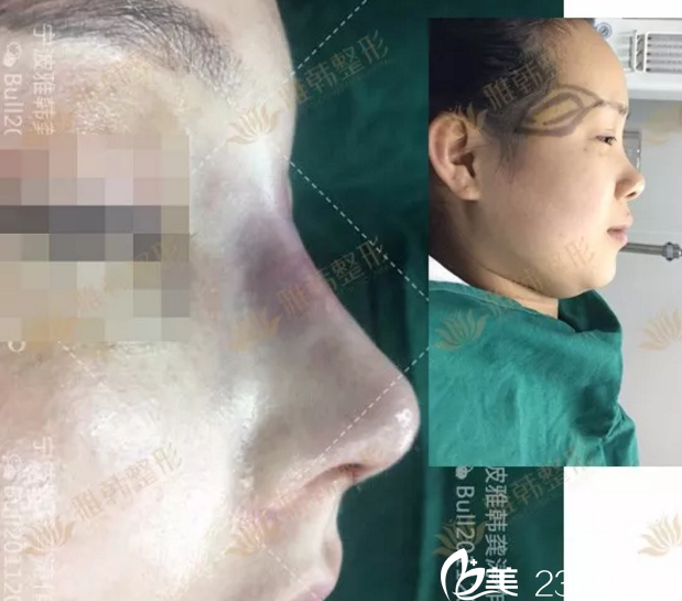 鼻综合手术刚完成时对比效果 鼻综合手术刚完成时对比效果