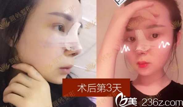 鼻综合整形手术第3天恢复照 鼻综合整形手术第3天恢复照