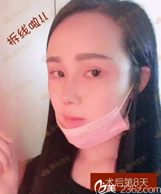 鼻综合手术第8天拆线照片 鼻综合手术第8天拆线照片